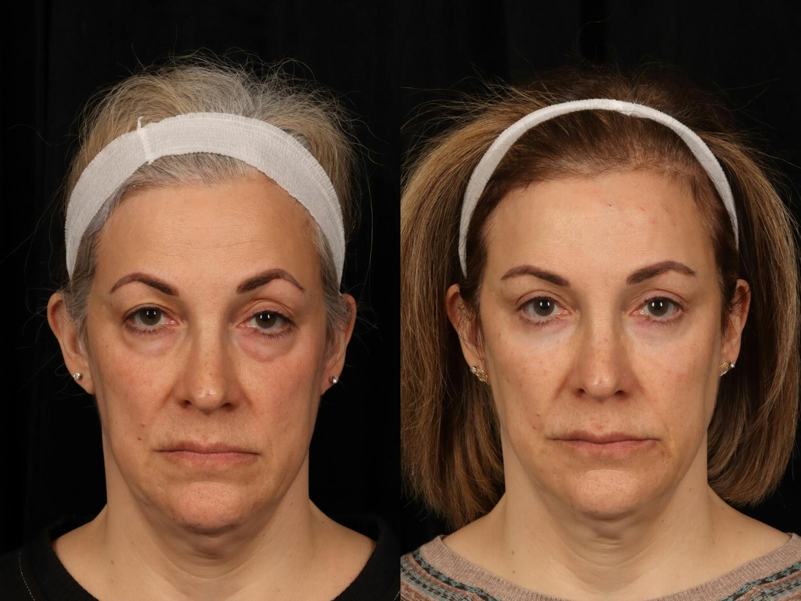 Blepharoplasty Before & After Gallery - Patient 272798 - Image 1