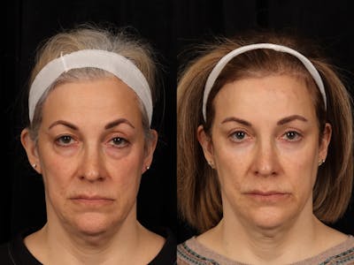 Blepharoplasty Before & After Gallery - Patient 272798 - Image 1