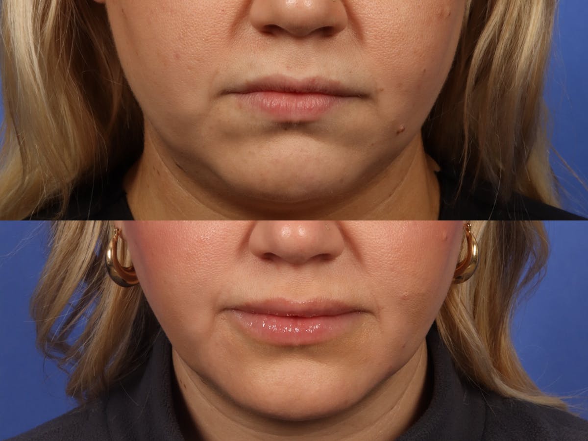 UltraClear™ Laser Before & After Gallery - Patient 115880 - Image 1