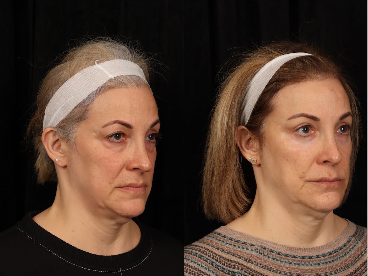 Blepharoplasty Before & After Gallery - Patient 272798 - Image 2