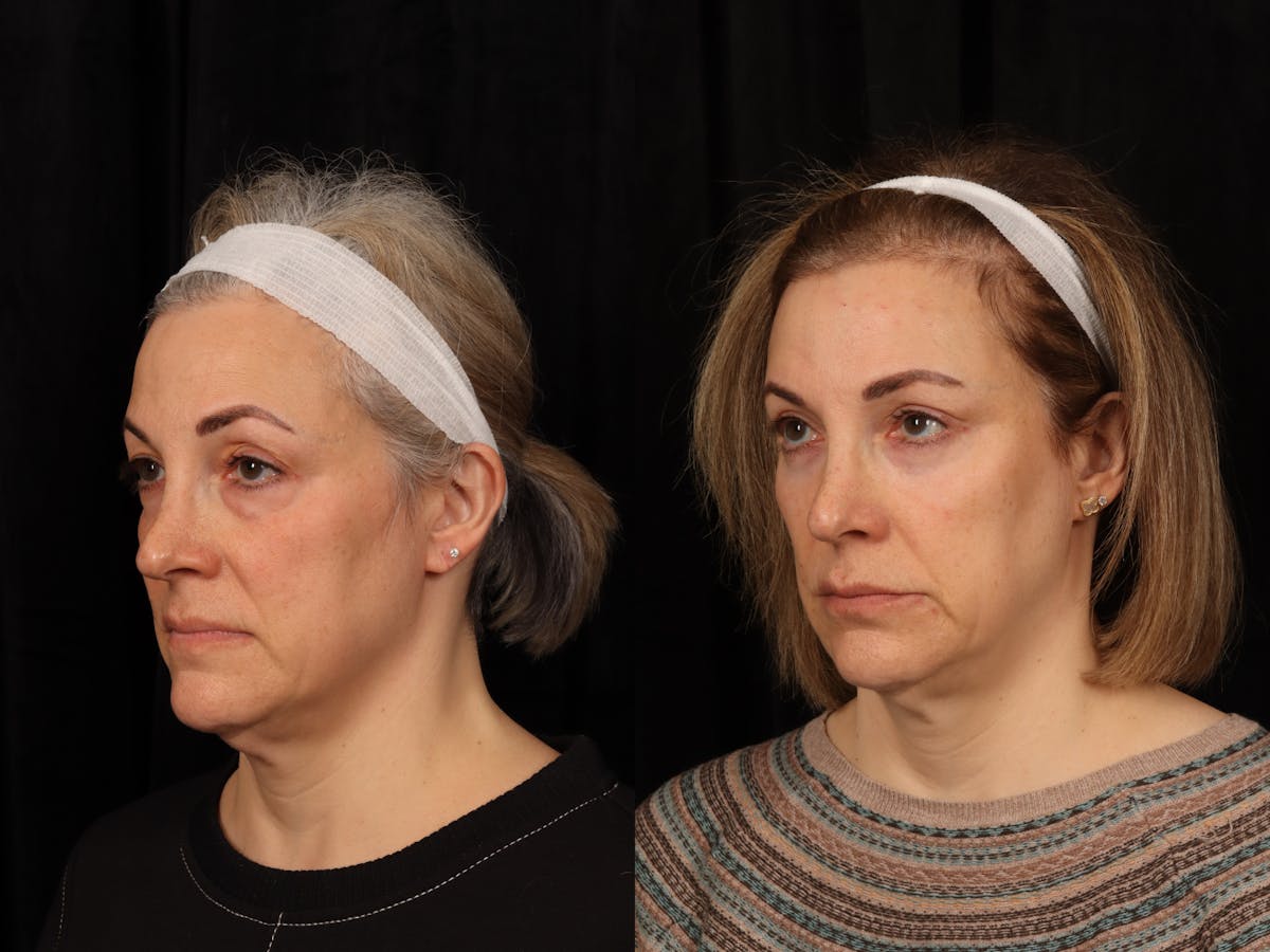 Blepharoplasty Before & After Gallery - Patient 272798 - Image 3