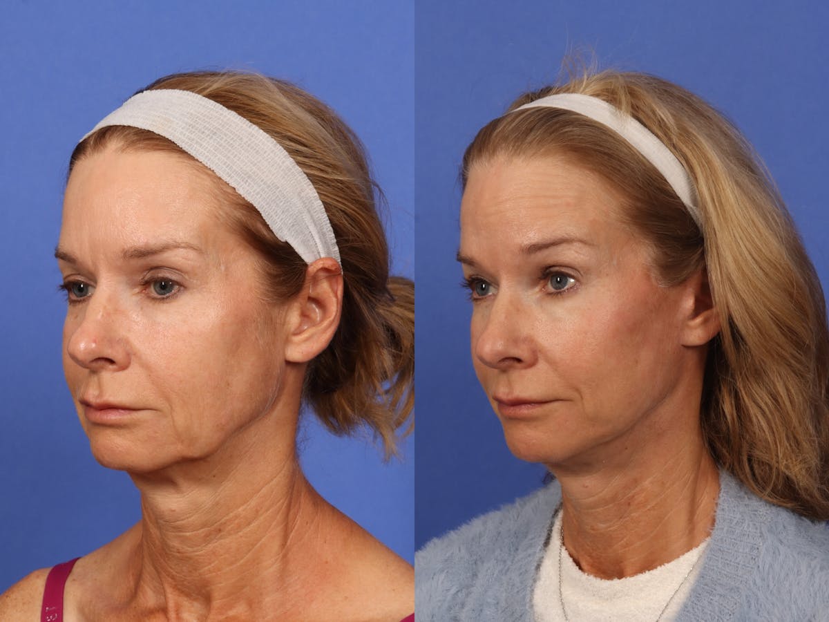 Brow Lift Before & After Gallery - Patient 467102 - Image 3