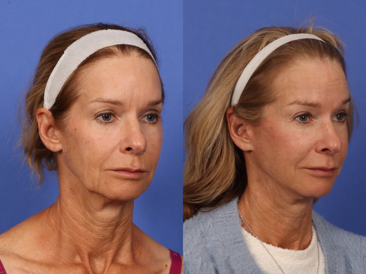 Brow Lift Before & After Gallery - Patient 467102 - Image 2