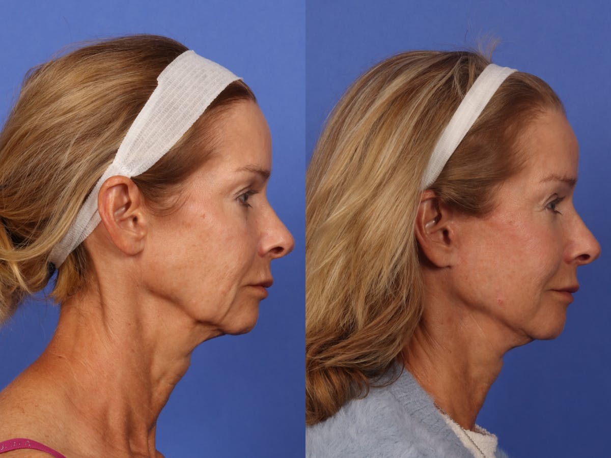 Brow Lift Before & After Gallery - Patient 467102 - Image 5