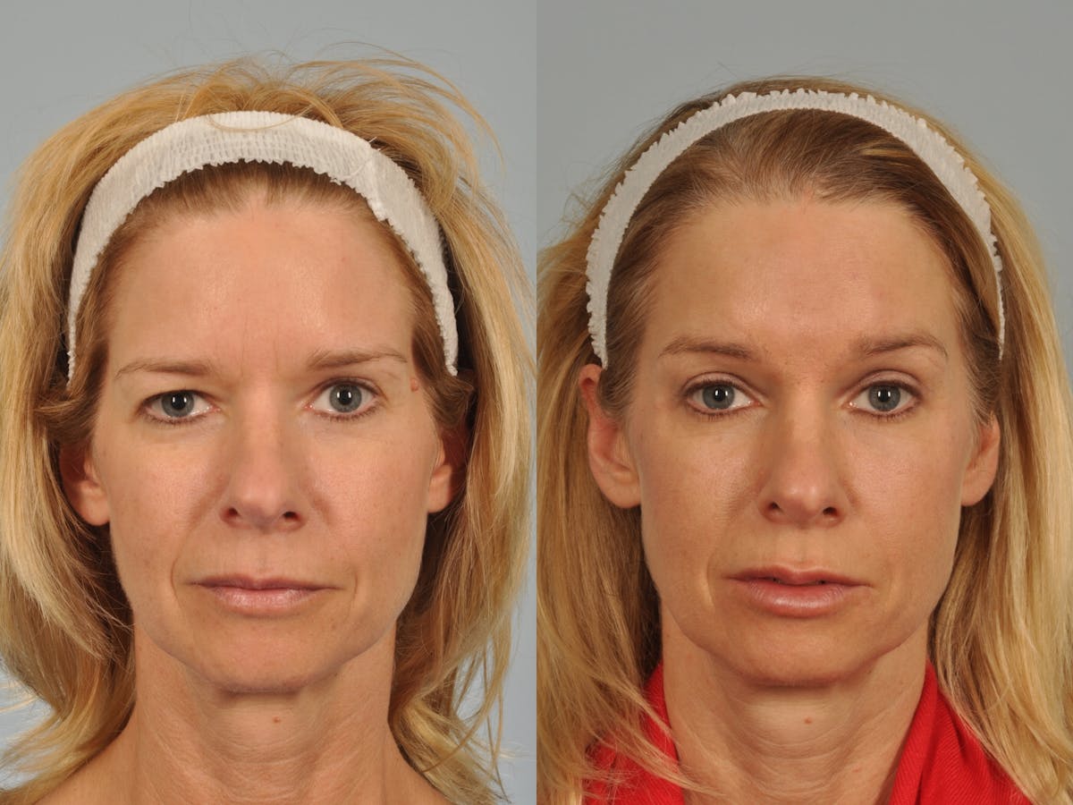 Brow Lift Before & After Gallery - Patient 467102 - Image 1