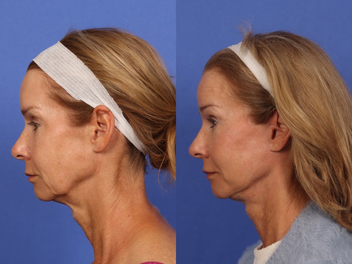 Brow Lift Before & After Gallery - Patient 467102 - Image 4