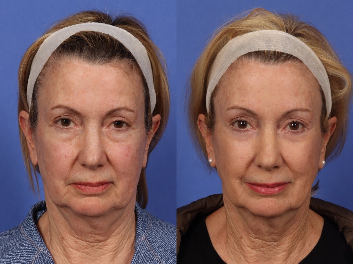 Liposculpture Before & After Gallery - Patient 305128 - Image 1