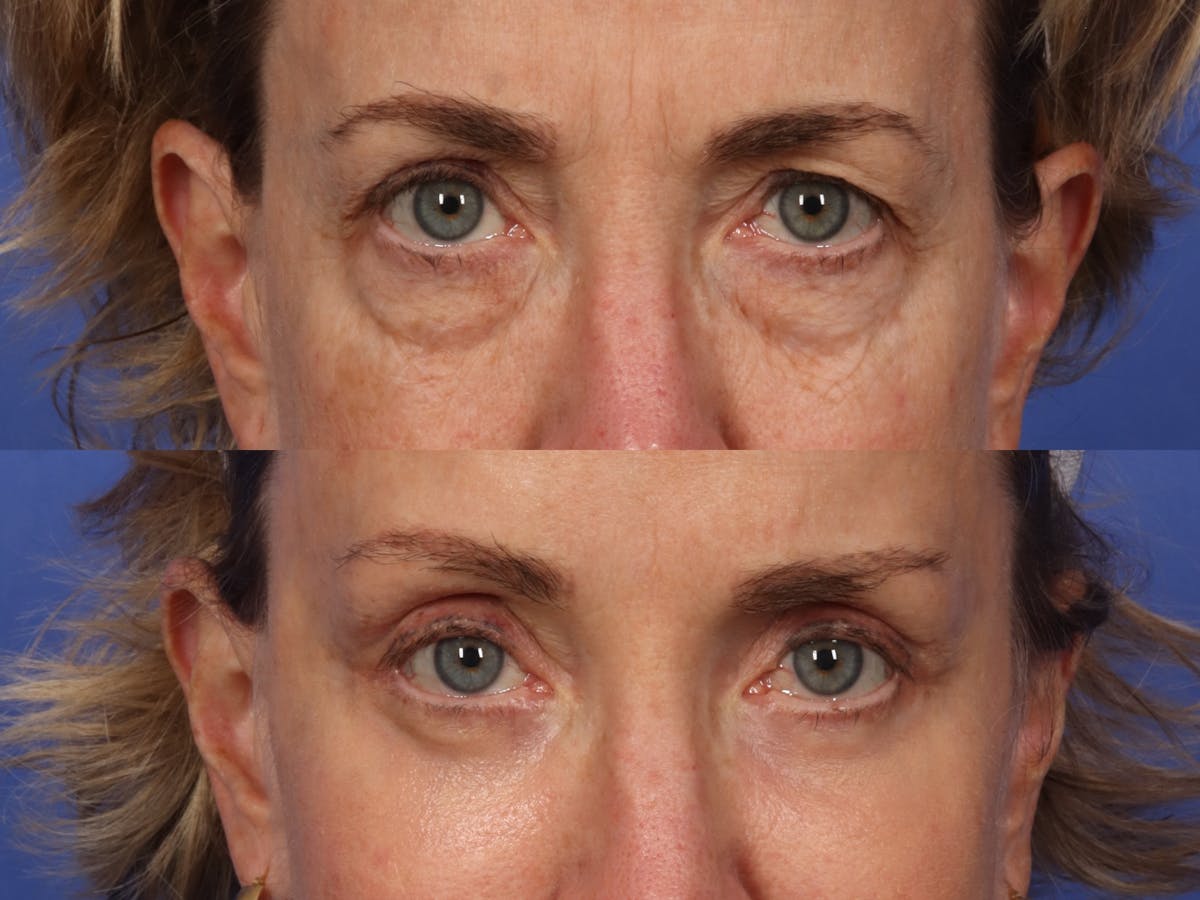 Blepharoplasty Before & After Gallery - Patient 424165 - Image 1