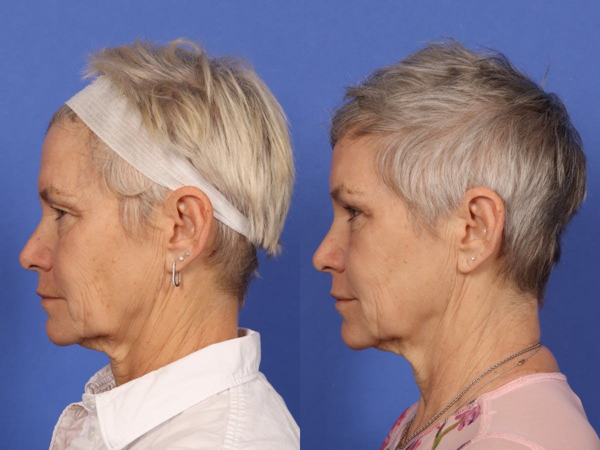 Blepharoplasty Before & After Gallery - Patient 281200 - Image 4
