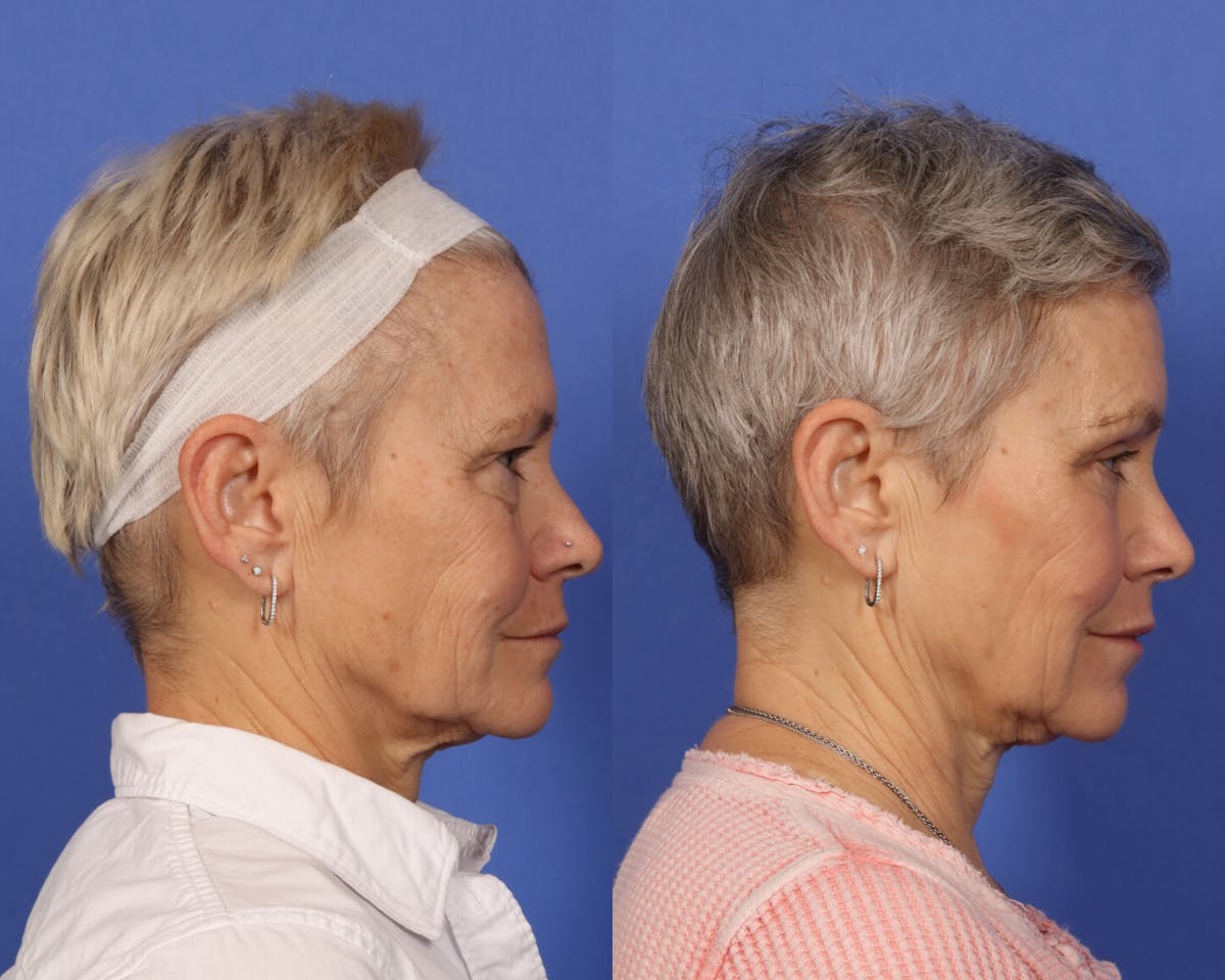 Blepharoplasty Before & After Gallery - Patient 281200 - Image 3