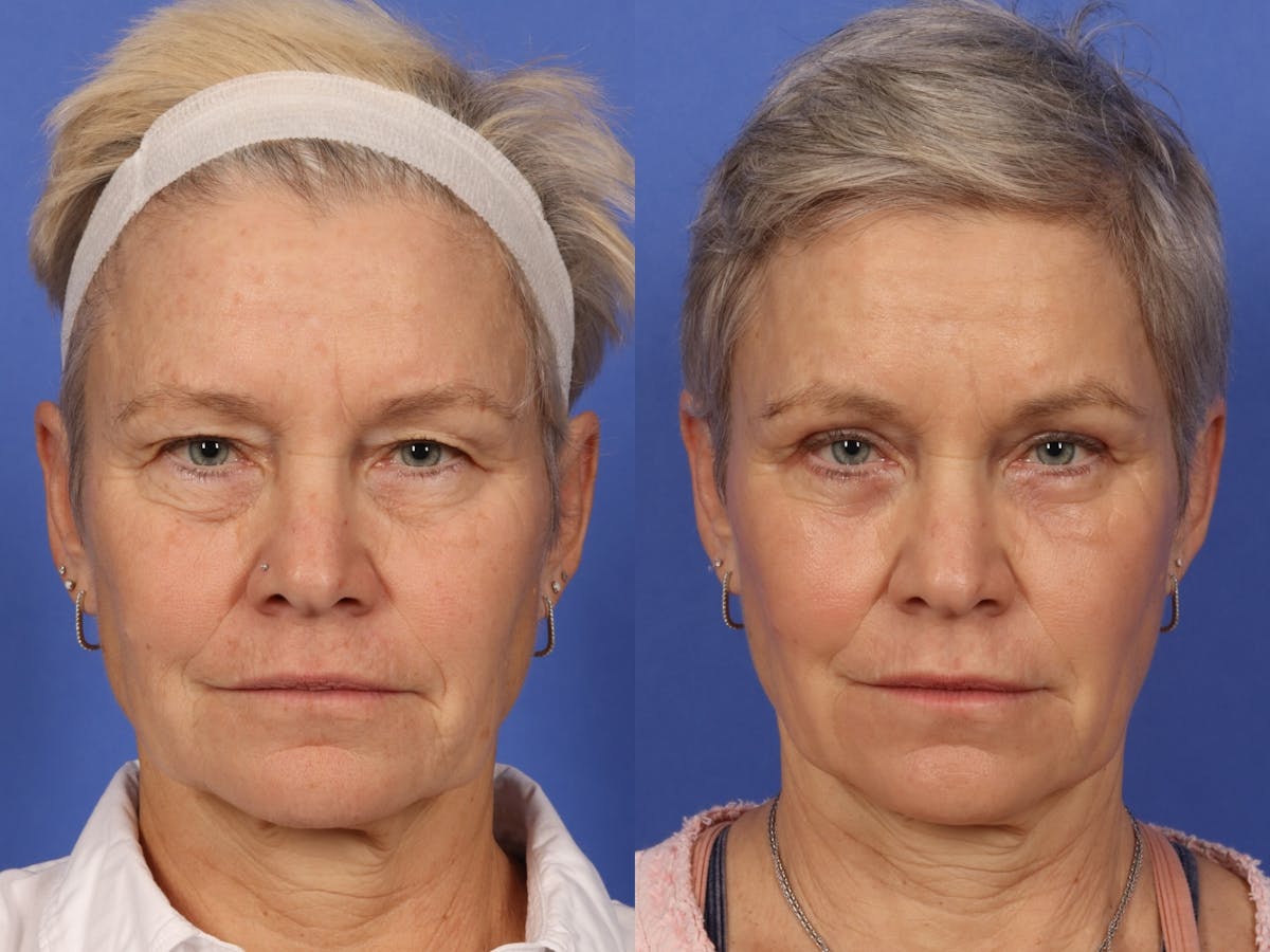Blepharoplasty Before & After Gallery - Patient 281200 - Image 1