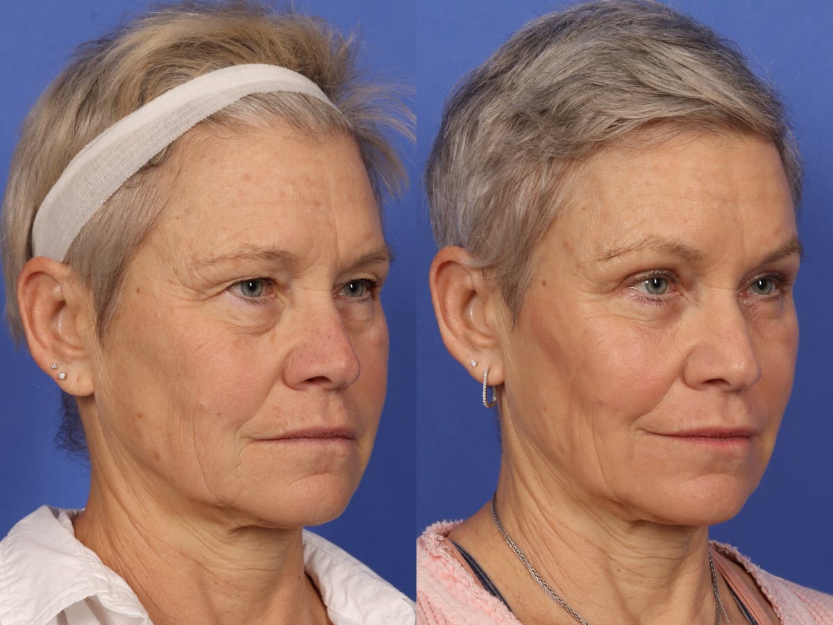 Blepharoplasty Before & After Gallery - Patient 281200 - Image 2