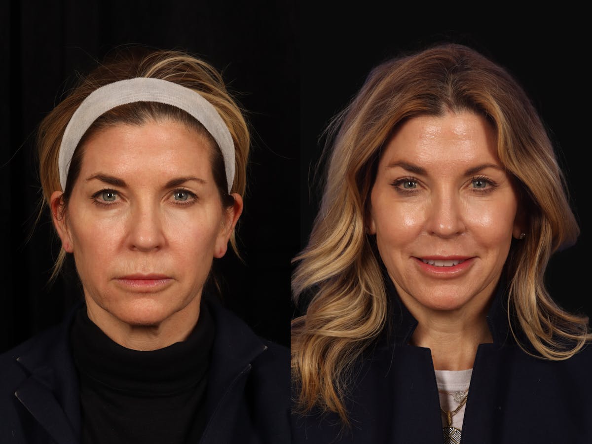 Liposculpture Before & After Gallery - Patient 324812 - Image 1