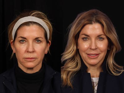Blepharoplasty Before & After Gallery - Patient 351061 - Image 1