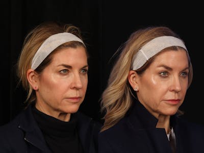 Liposculpture Before & After Gallery - Patient 324812 - Image 3