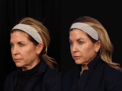 Liposculpture Before & After Gallery - Patient 324812 - Image 4