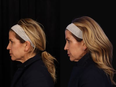 Liposculpture Before & After Gallery - Patient 324812 - Image 5