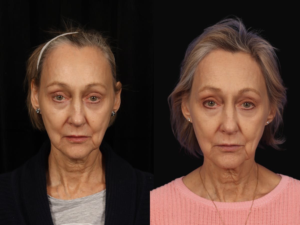 Liposculpture Before & After Gallery - Patient 703892 - Image 1