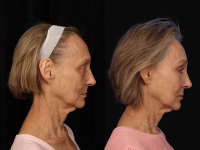 Mid Facelift Before & After Gallery - Patient 408893 - Image 3