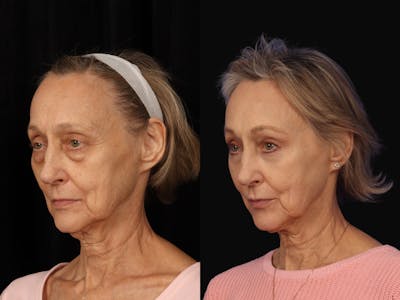 Mid Facelift Before & After Gallery - Patient 408893 - Image 4