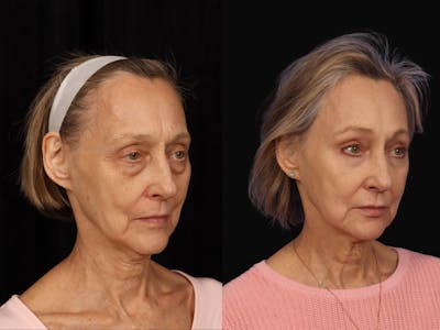 Mid Facelift Before & After Gallery - Patient 408893 - Image 2