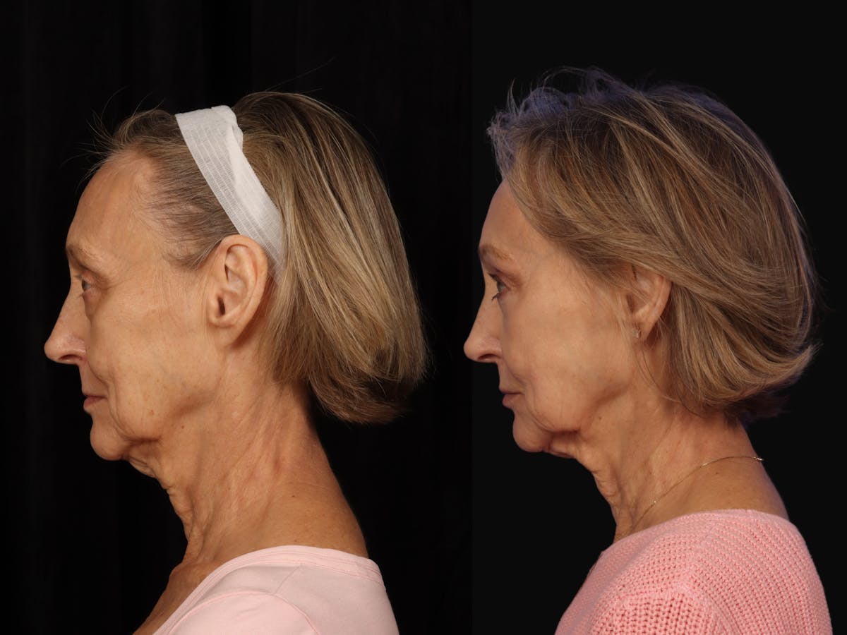 Liposculpture Before & After Gallery - Patient 703892 - Image 5