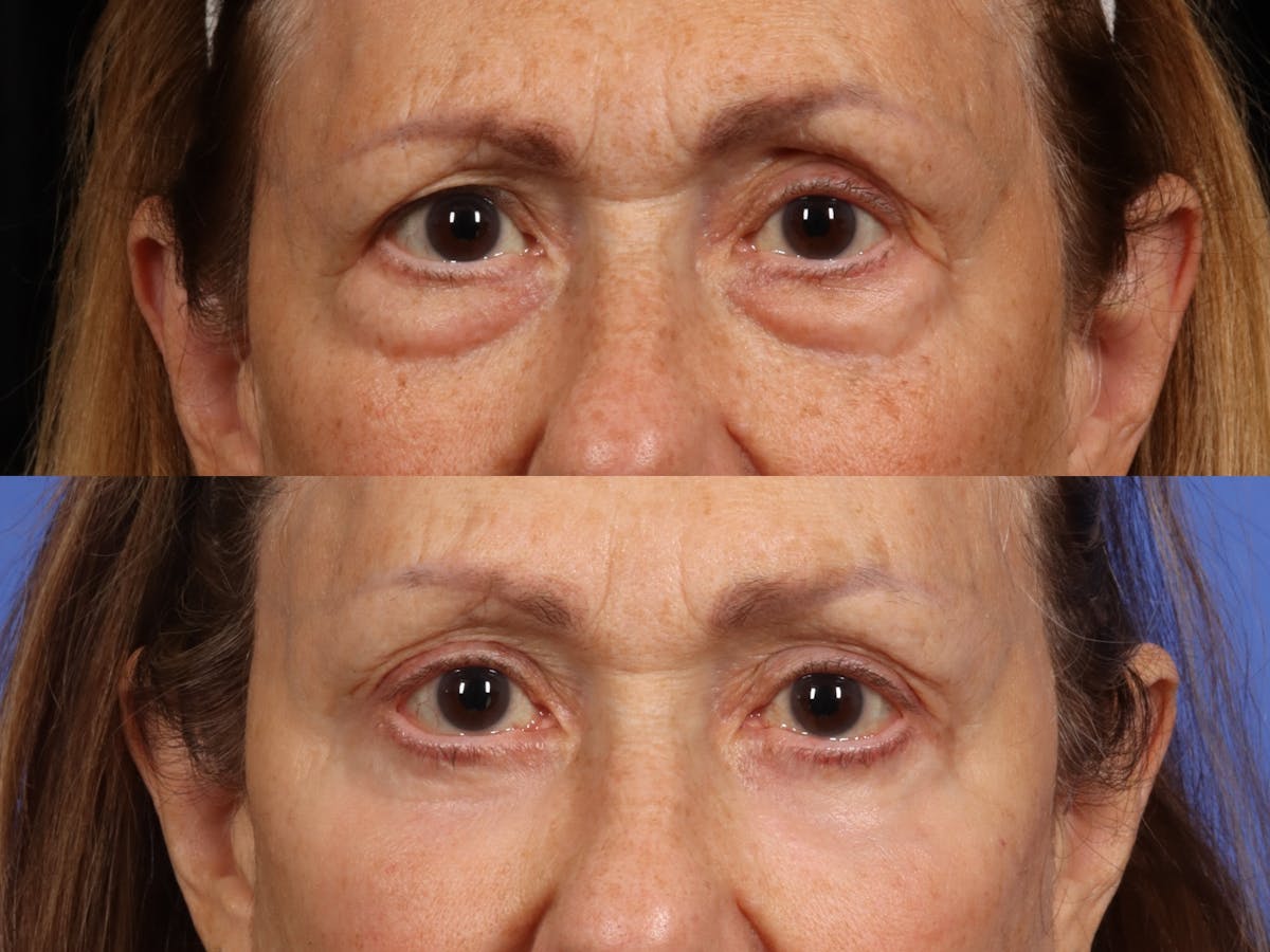 Brow Lift Before & After Gallery - Patient 242960 - Image 1