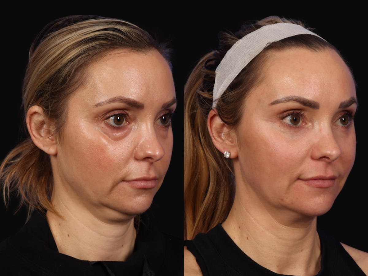 Mid Facelift Before & After Gallery - Patient 190026 - Image 3