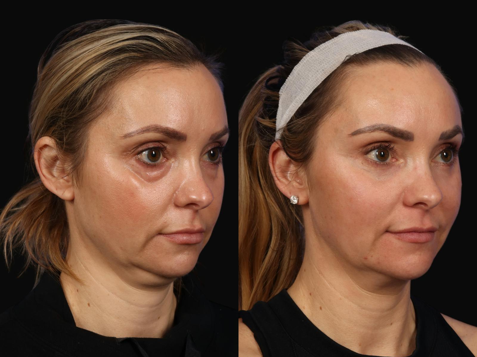 Liposculpture Before & After Gallery - Patient 407049 - Image 3