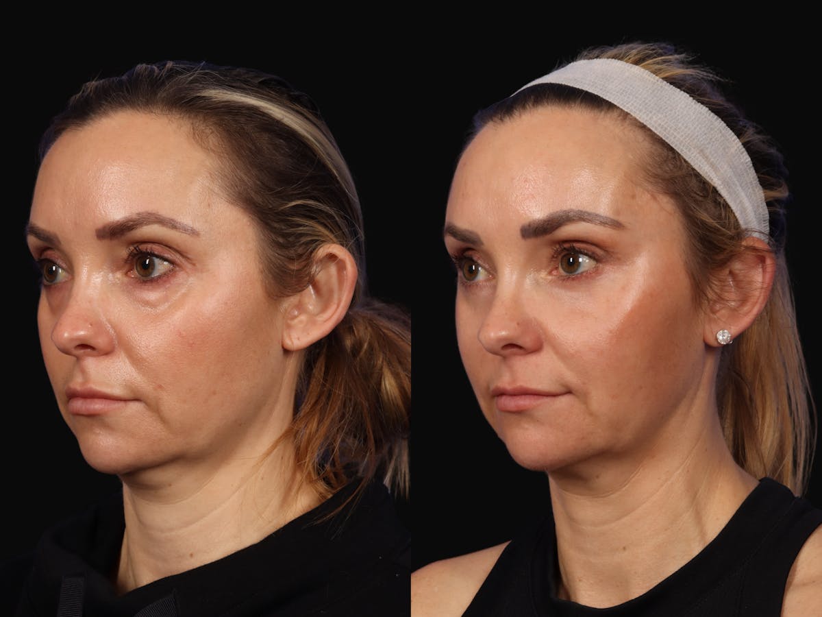 Mid Facelift Before & After Gallery - Patient 190026 - Image 2