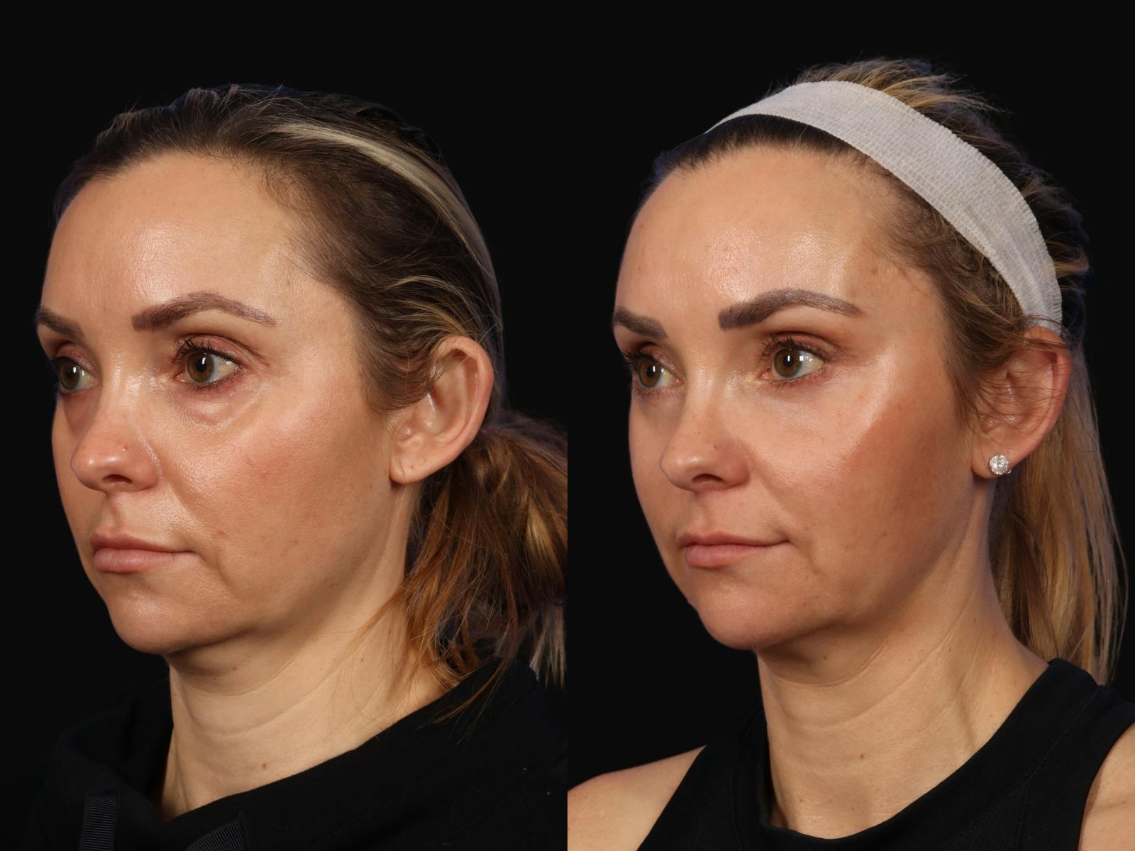 Liposculpture Before & After Gallery - Patient 407049 - Image 2