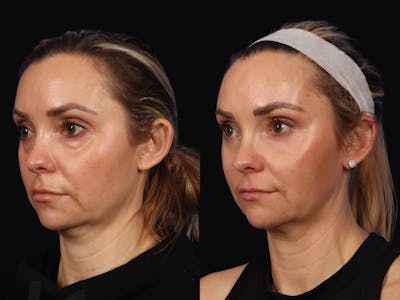 Mid Facelift Before & After Gallery - Patient 292468 - Image 2