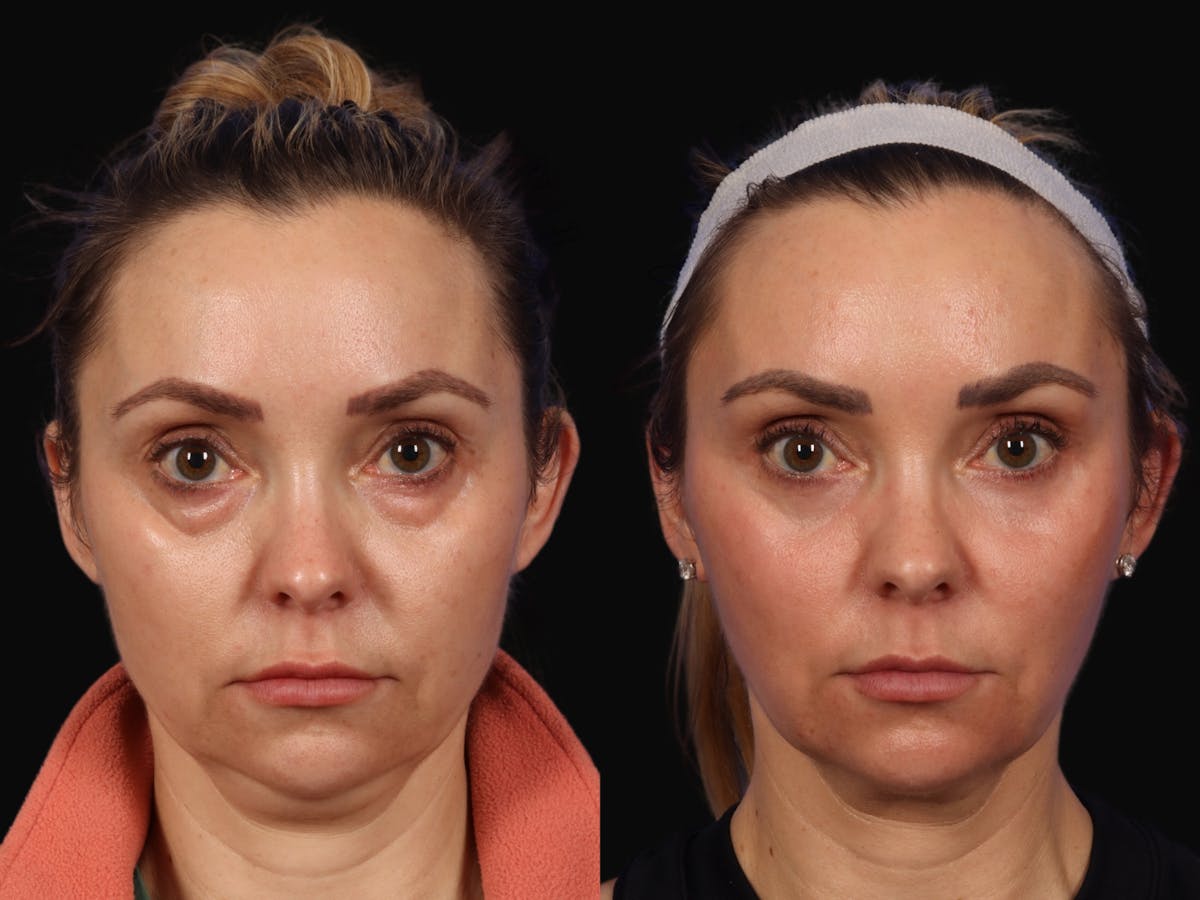 Mid Facelift Before & After Gallery - Patient 190026 - Image 1