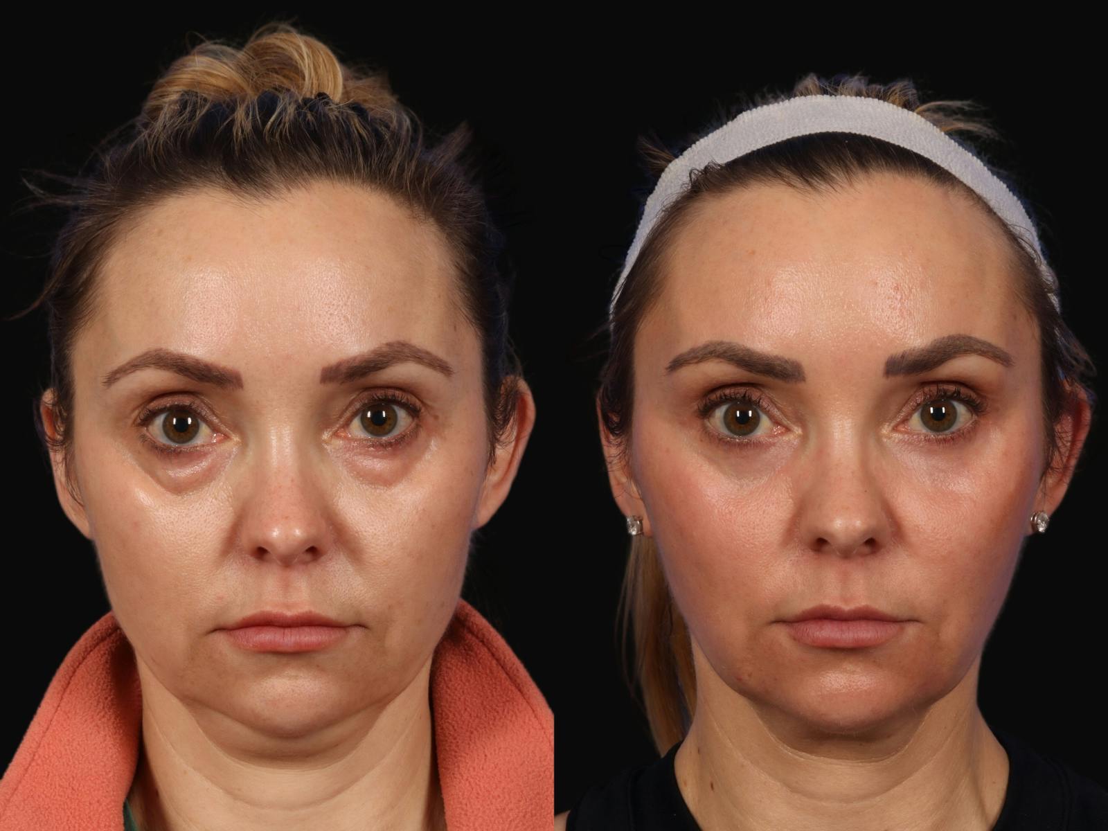 Liposculpture Before & After Gallery - Patient 407049 - Image 1