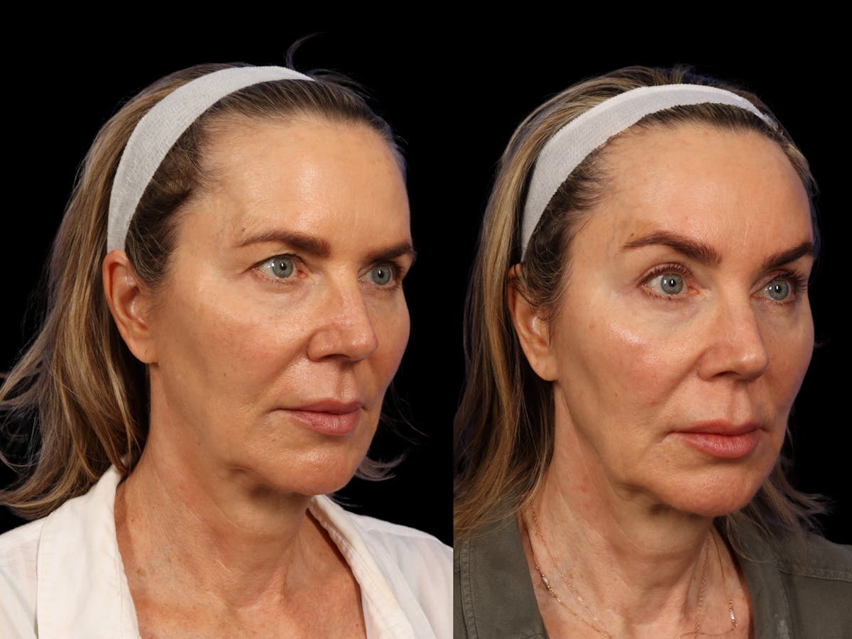 Brow Lift Before & After Gallery - Patient 265783 - Image 2
