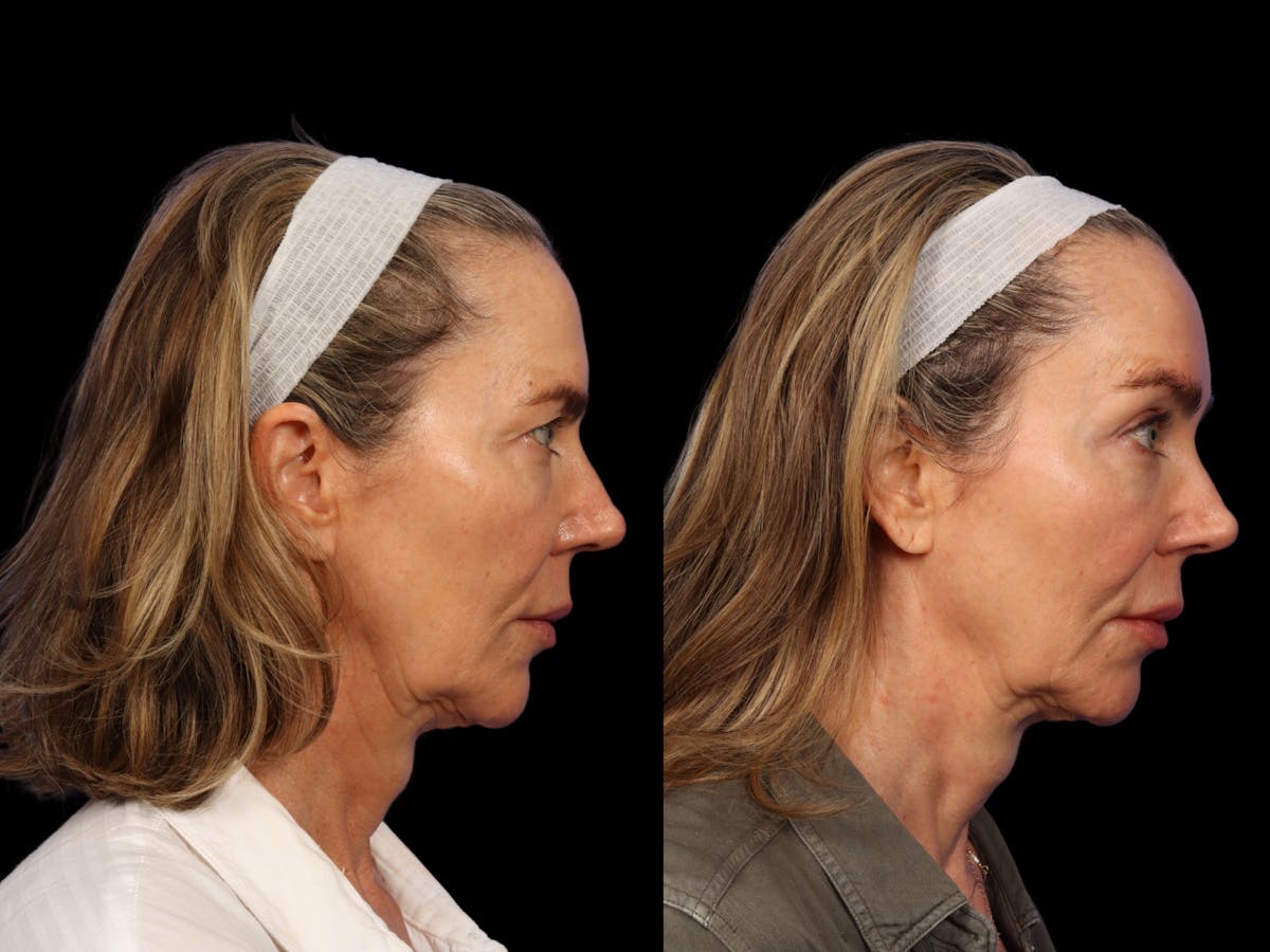 Brow Lift Before & After Gallery - Patient 265783 - Image 4
