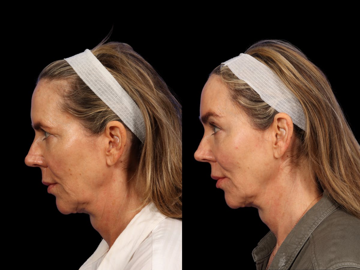 Brow Lift Before & After Gallery - Patient 265783 - Image 3