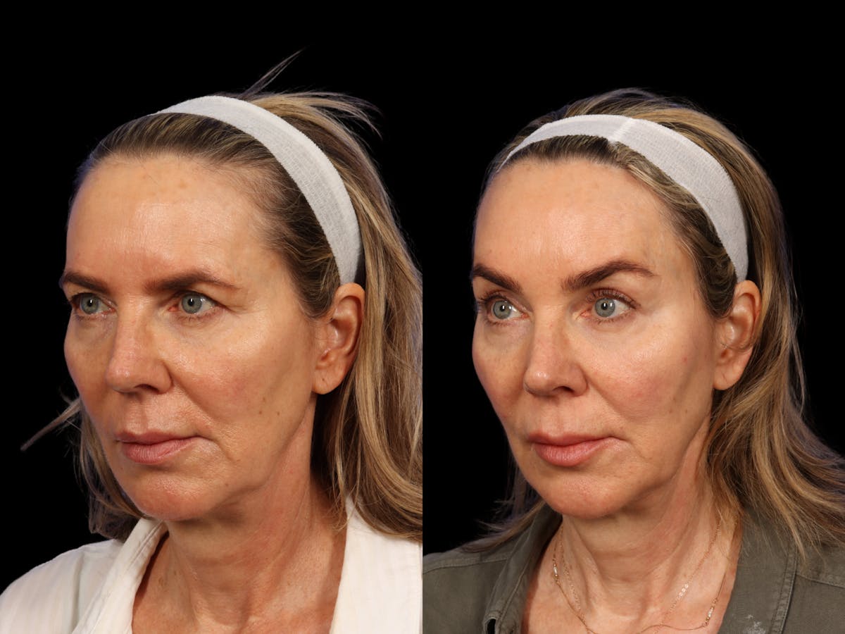 Brow Lift Before & After Gallery - Patient 265783 - Image 5