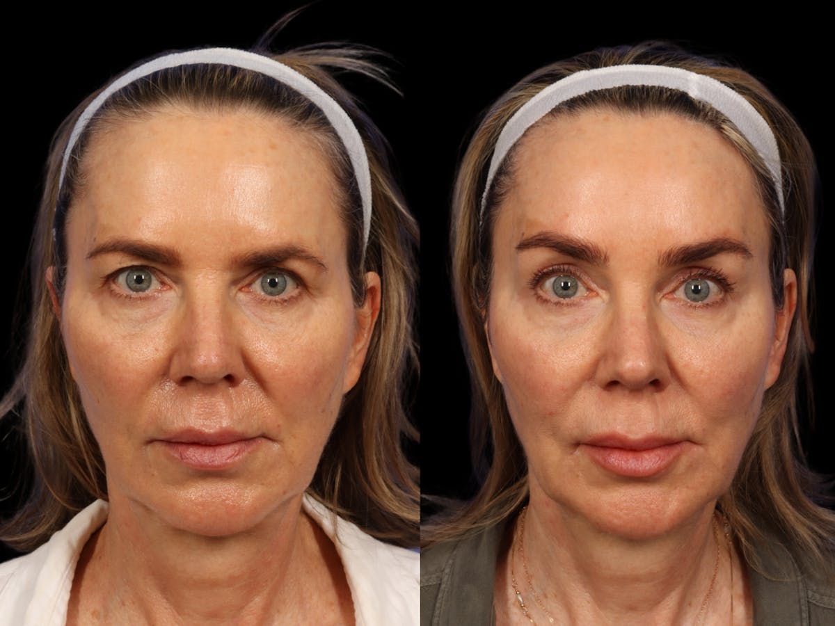 Brow Lift Before & After Gallery - Patient 265783 - Image 1