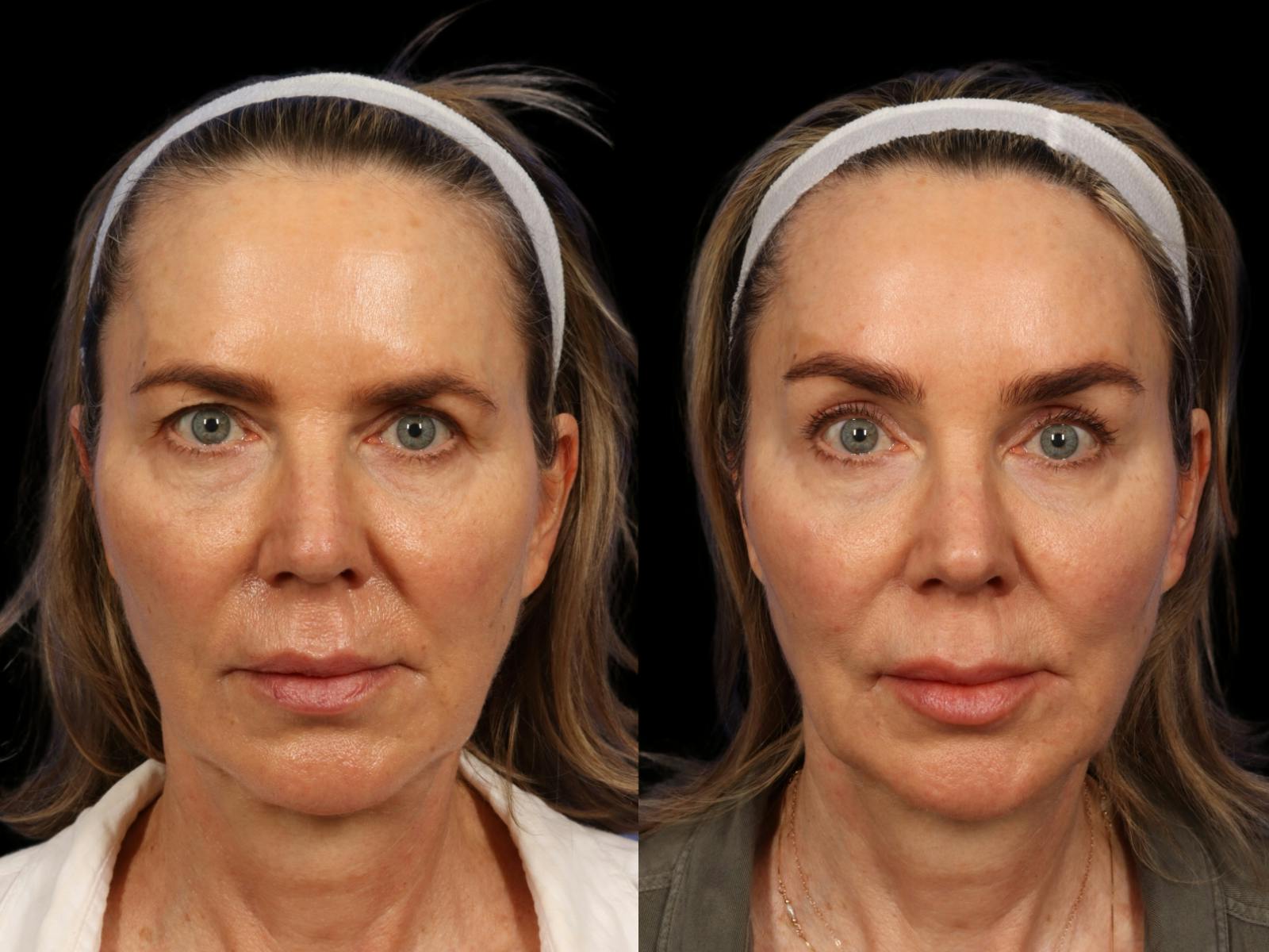 Brow Lift Before & After Gallery - Patient 814986 - Image 1