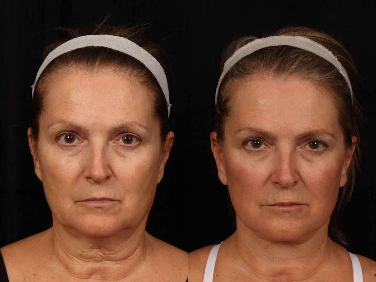 Facelift Before & After Gallery - Patient 319584 - Image 1