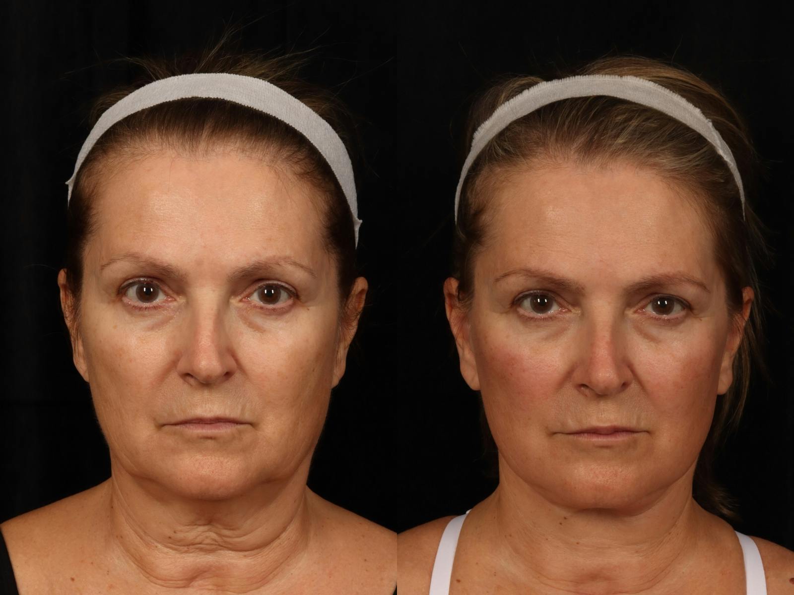 Liposculpture Before & After Gallery - Patient 291157 - Image 1