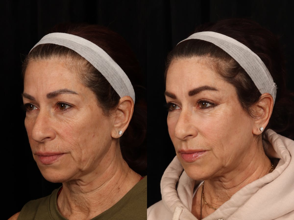 Blepharoplasty Before & After Gallery - Patient 108389 - Image 3