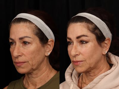 Mid Facelift Before & After Gallery - Patient 318602 - Image 3