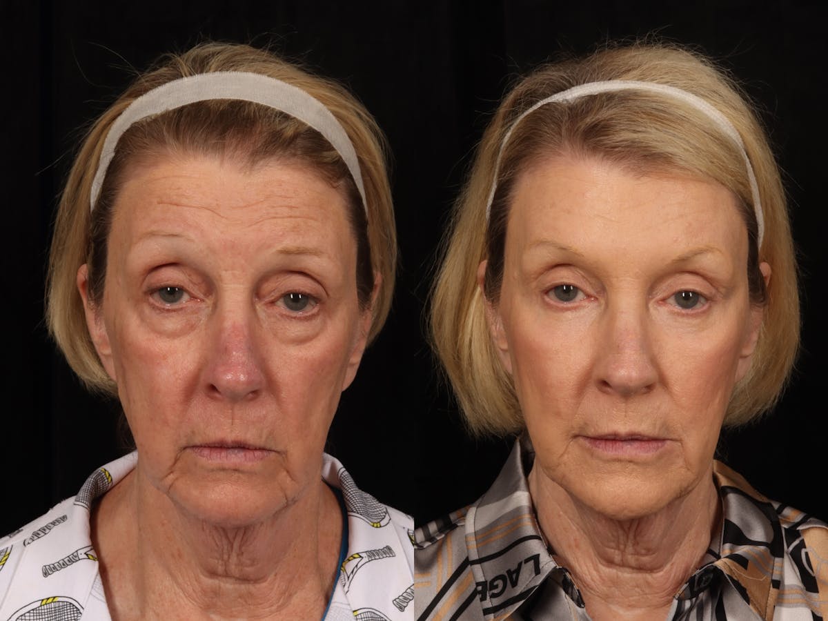 Blepharoplasty Before & After Gallery - Patient 232542 - Image 1