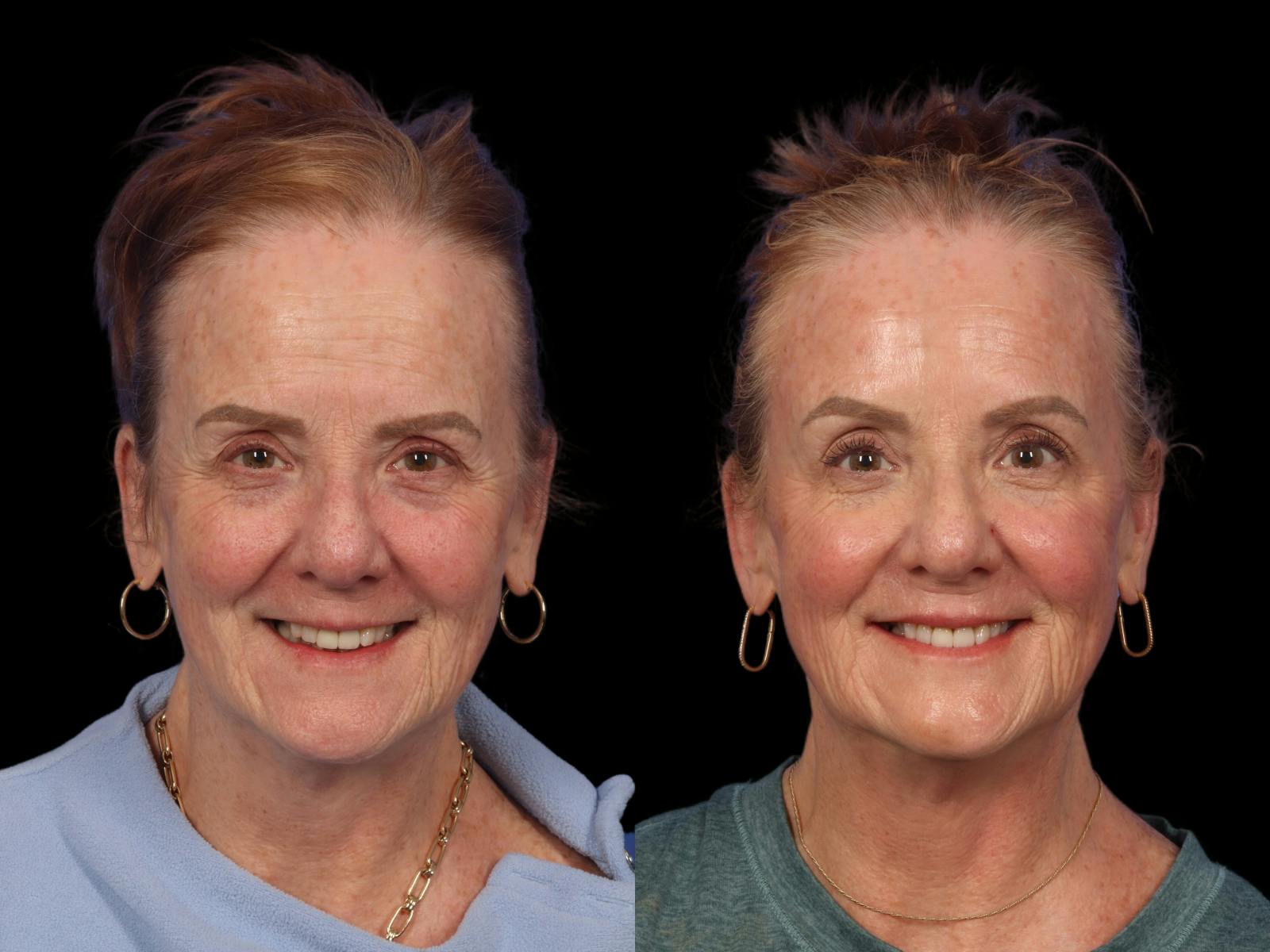 Fillers Before & After Gallery - Patient 859626 - Image 1