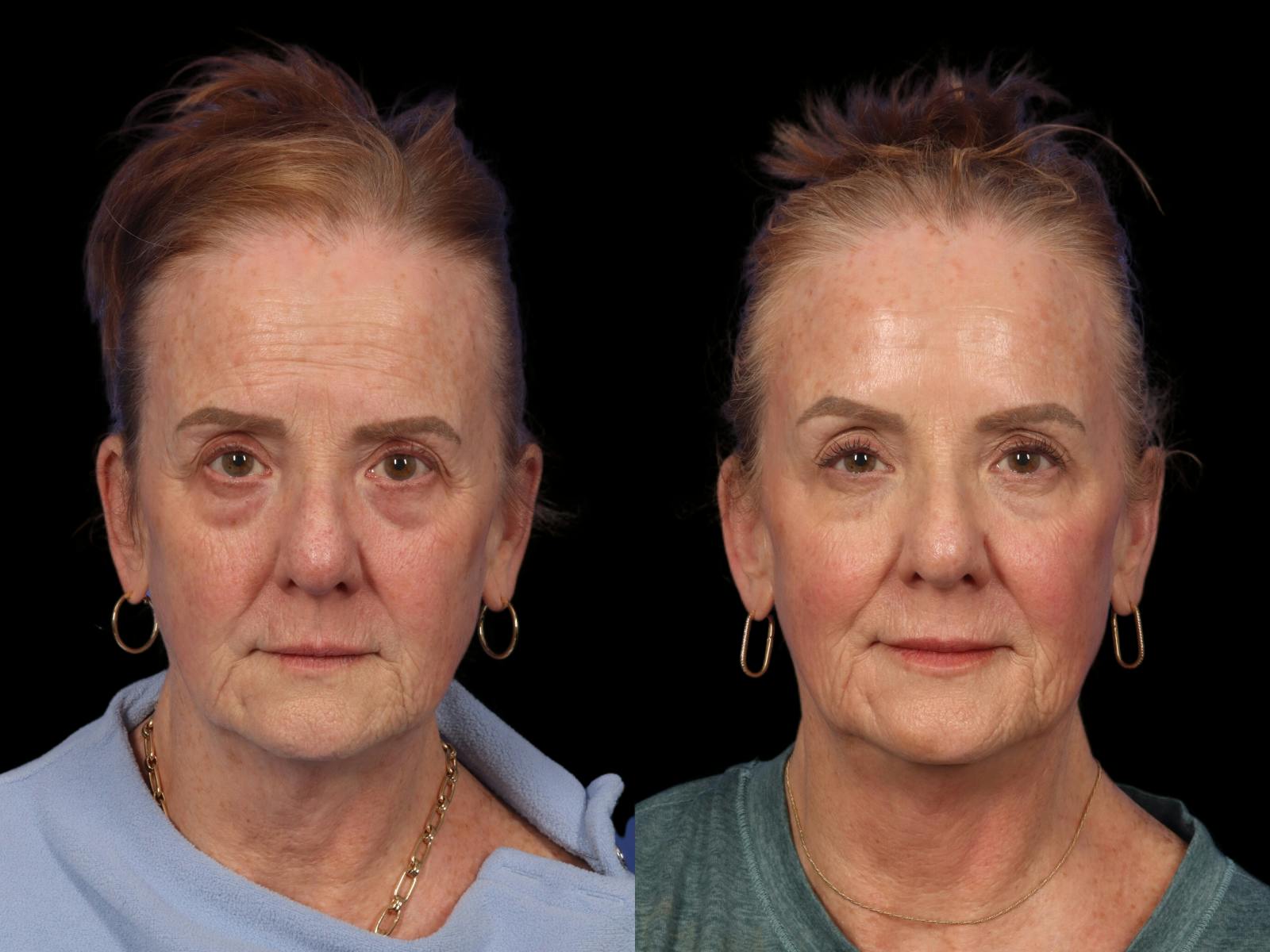Fillers Before & After Gallery - Patient 859626 - Image 3