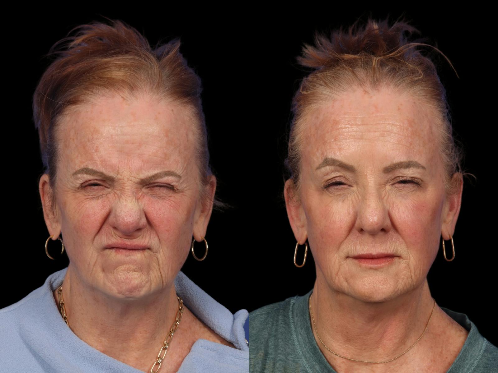 Fillers Before & After Gallery - Patient 859626 - Image 2
