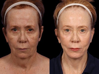 Chin Implant Before & After Gallery - Patient 281998 - Image 1