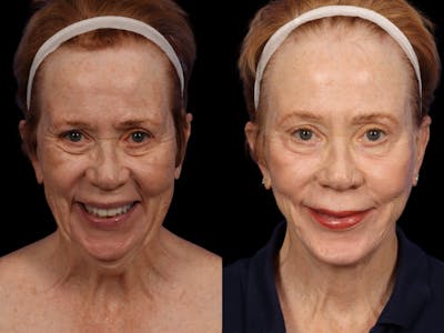 Facelift Before & After Gallery - Patient 296113 - Image 2